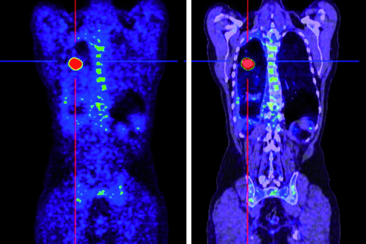 Helios Hospital in Berlin Buch offers MIBG Therapy: treatment of advanced-stage neuroendocrine tumor